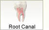 Root Canal